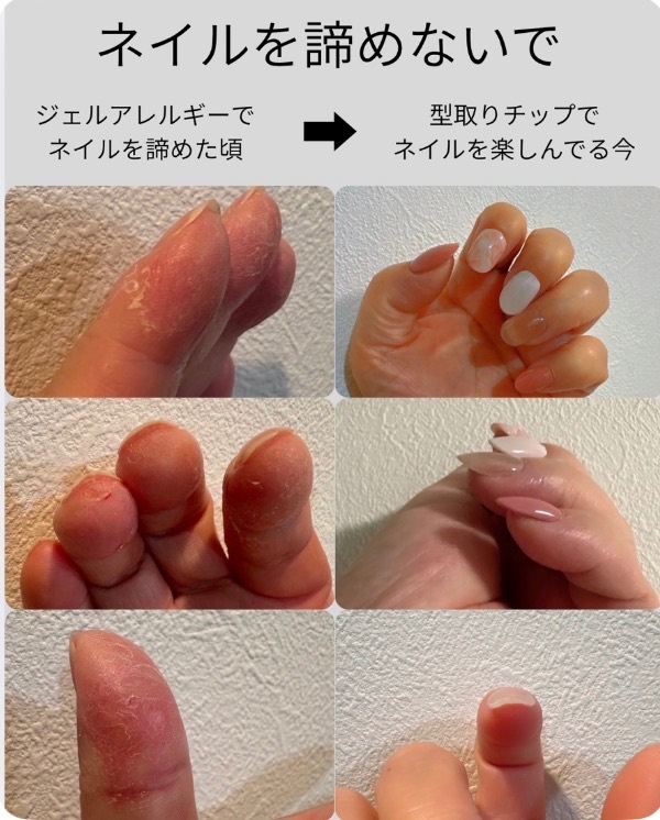 ジェルアレルギー対応・爪の型から作る完全オーダーメイドネイルチップ（歯科素材使用） 1枚目